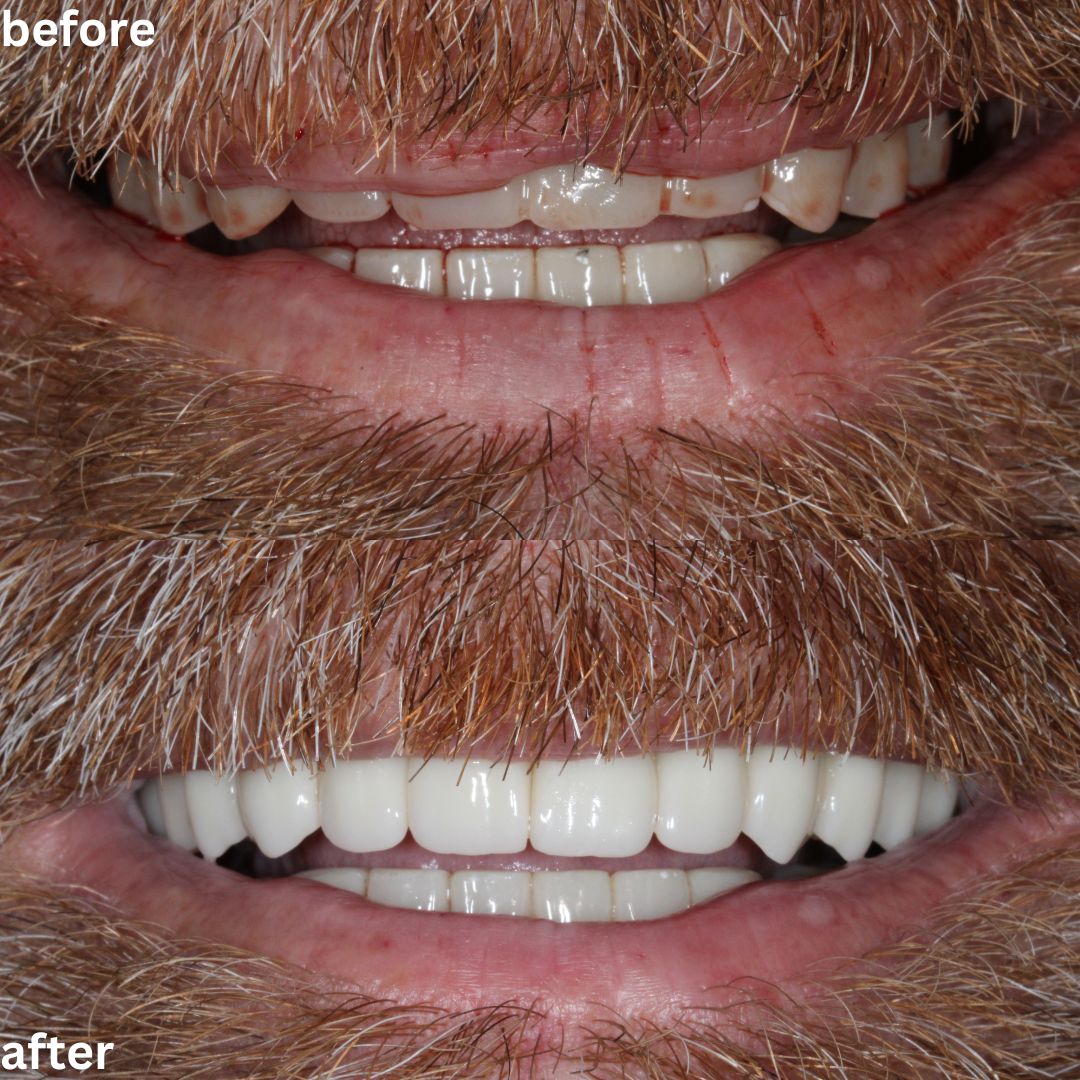 upper permanent denture before and after
