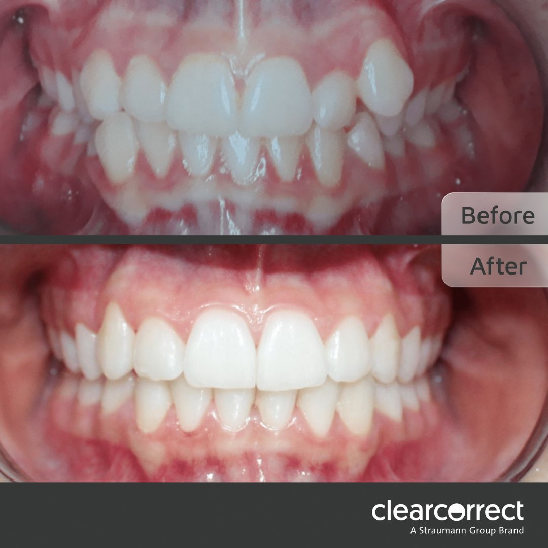 ClearCorrect™ Clear Aligners before and after
