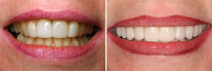 Dental Patient Before and After